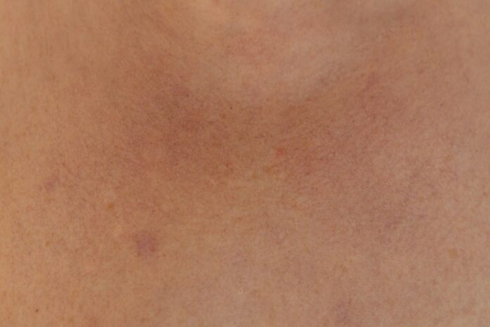 Photo by Olga Thelavart a close up of a person's back with acne on it