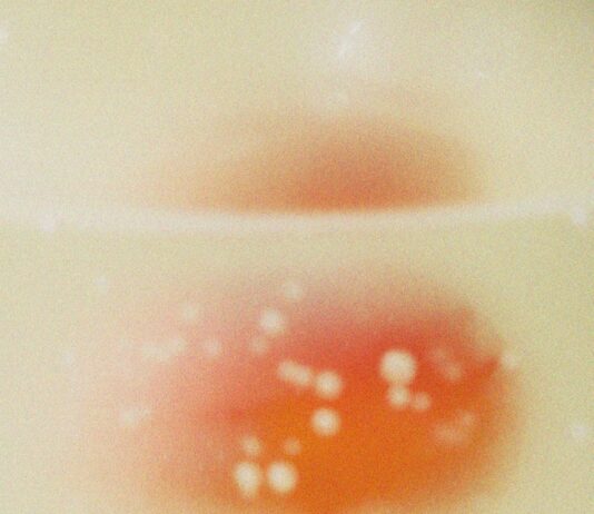 “갑자기 입안이 헐었어요”…초여름 ‘면역 저하’가 만든 구내염 A red and orange blob with white spots.